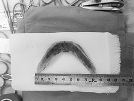 上顎前突におけるLe Fort（ルフォー）I型骨切り術とオトガイ形成術を行ってきました。